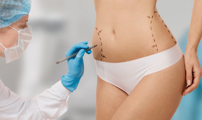 Vaser Liposuction